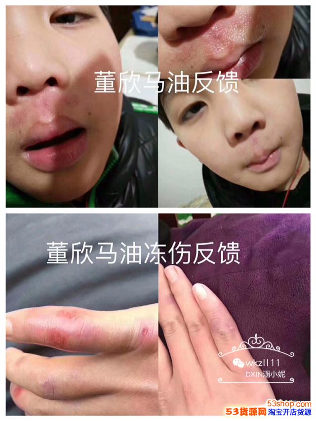 宝宝上火,鼻子下面都被熏烂了