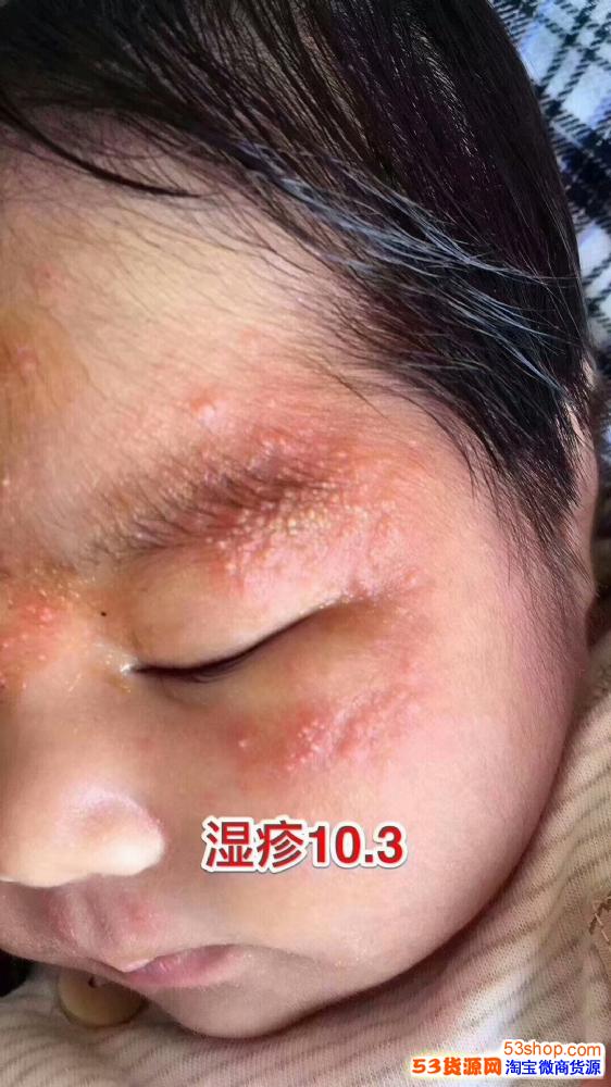 活肤之泉t泉孕妇宝宝可以使用吗宝宝湿疹可以用吗