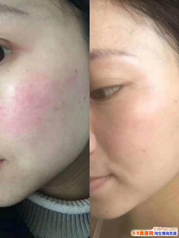 董欣代理教你区分"过敏"还是"春敏",董欣洋甘菊和芦荟胶帮您忙