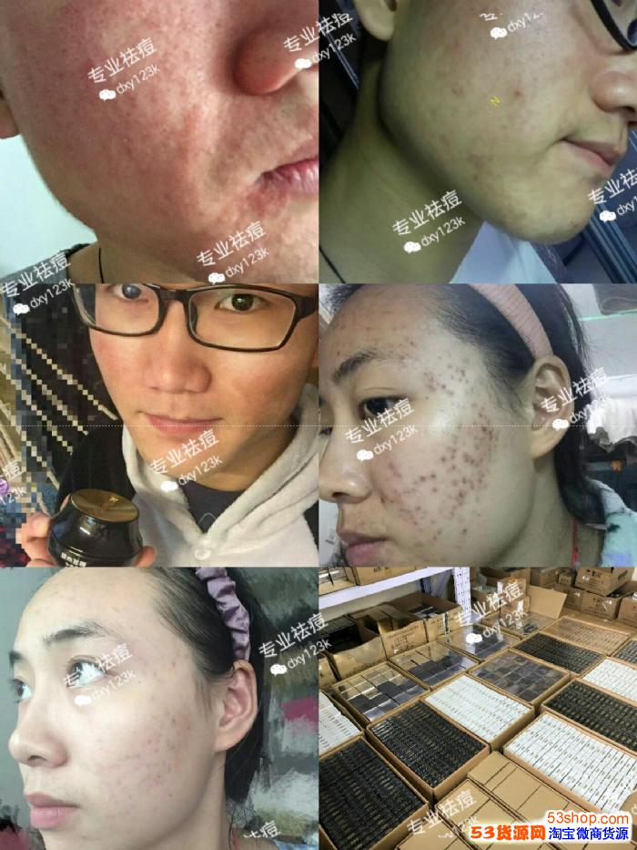 极尚名膜祛痘反馈是真实的吗官方联系方式多少
