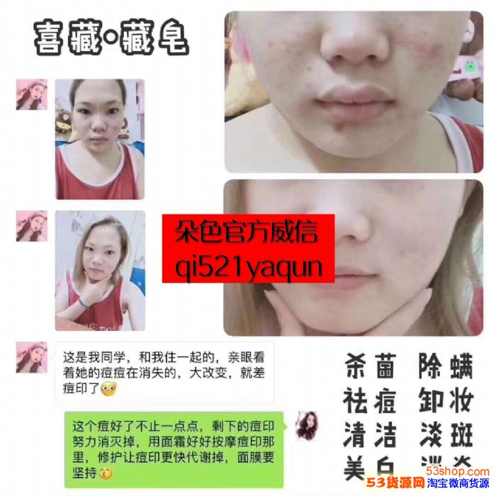 过敏痘痘图片症状,过敏痘痘图片,过敏痘痘图片_大山谷图库