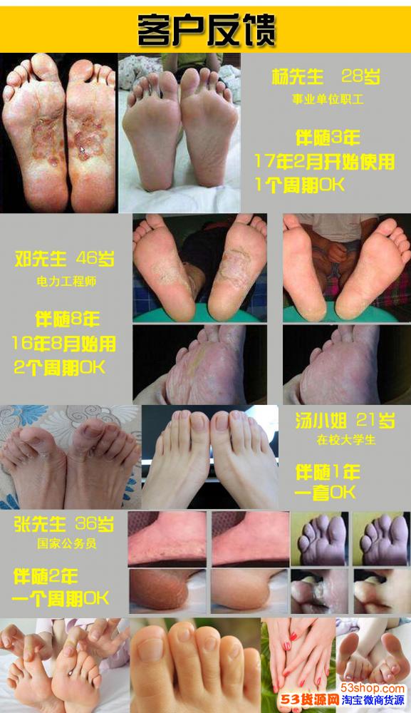 步生花抑菌液如何轻松根治脚气步生花产品介绍