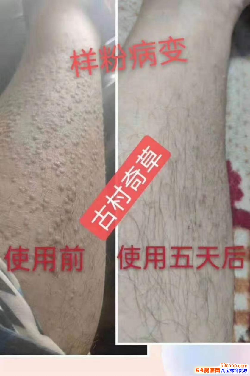 古村奇草抑菌膏是牛皮癣花斑癣的克星