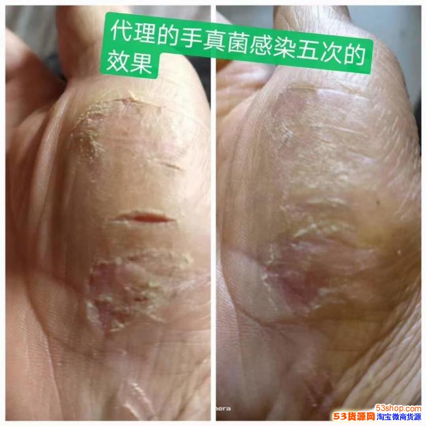 古村奇草抑菌膏治皮肤病真的那么神奇吗