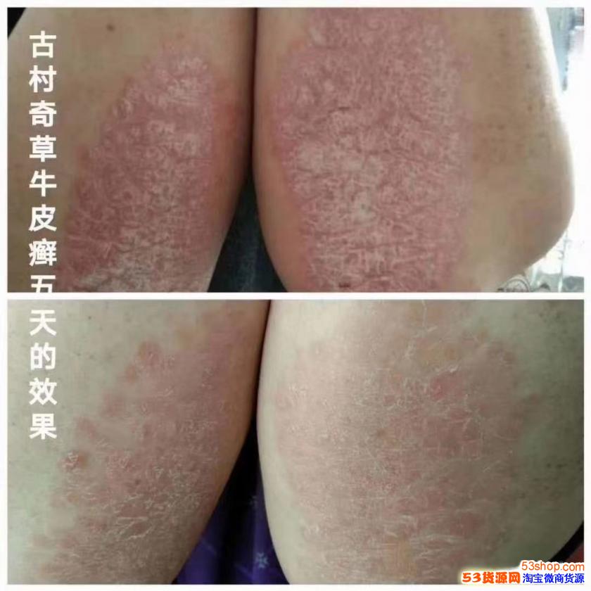 古村奇草抑菌膏治皮肤病真的那么神奇吗